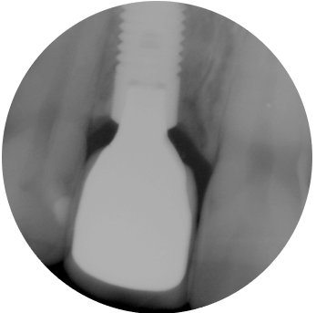 Implantat - knogleopbygning